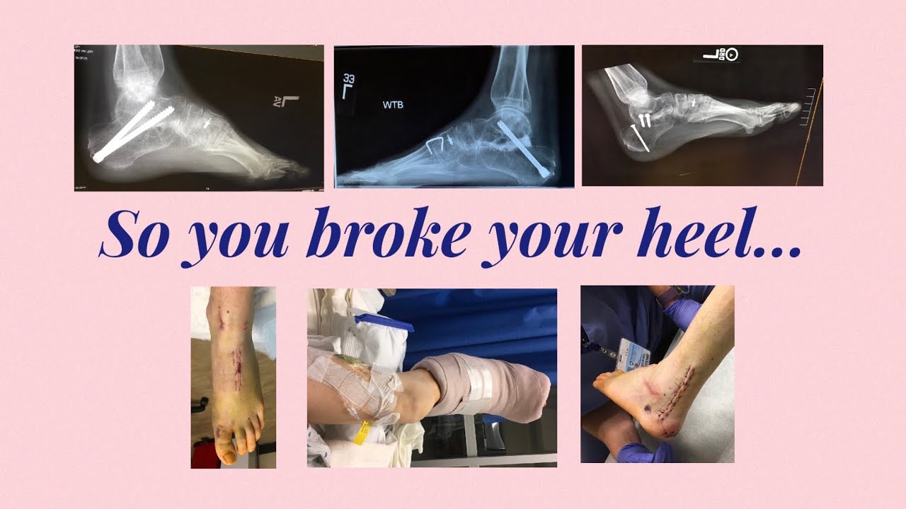 Broken Heel Recovery Tips & Tricks