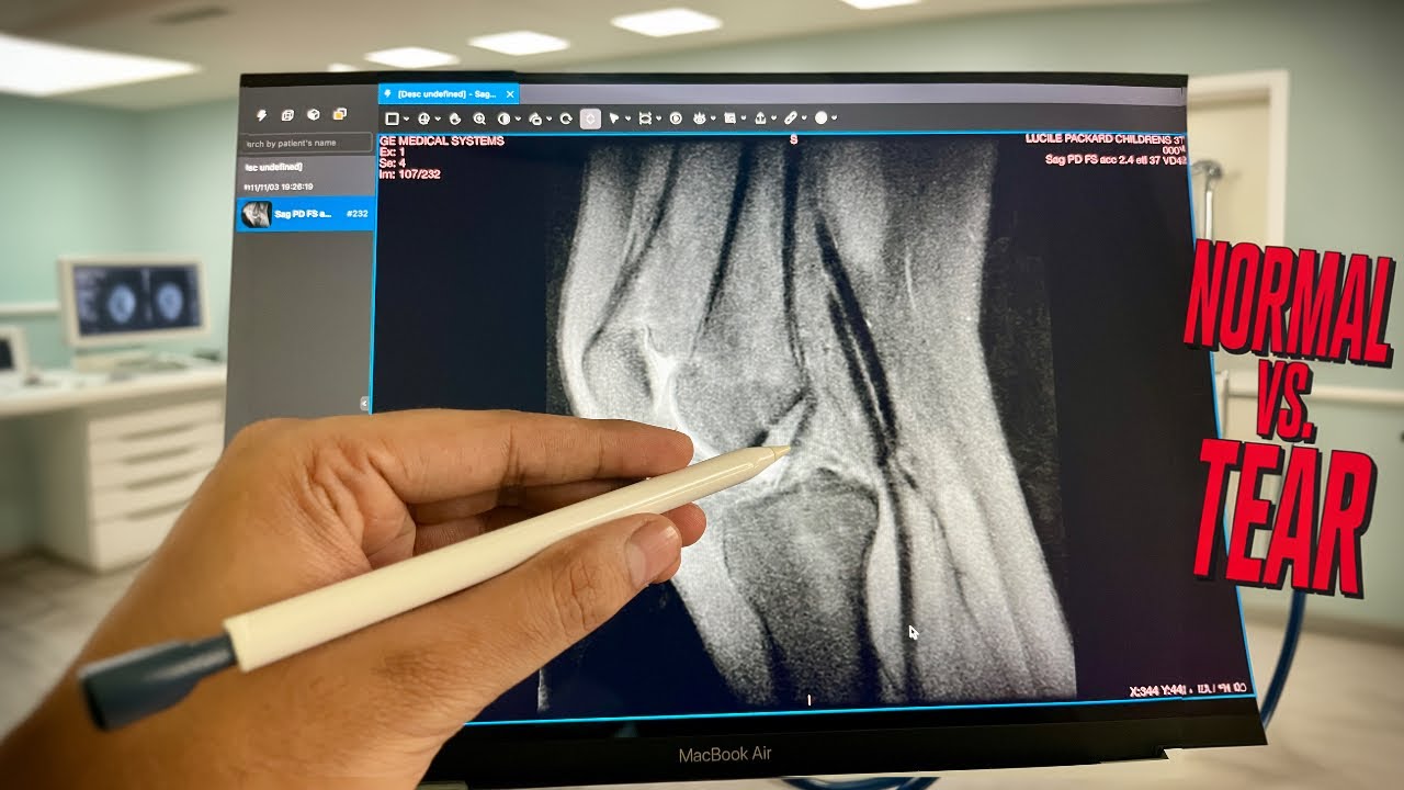 ACL Tear on MRI: Normal vs Complete Tear (Made Easy for Students)