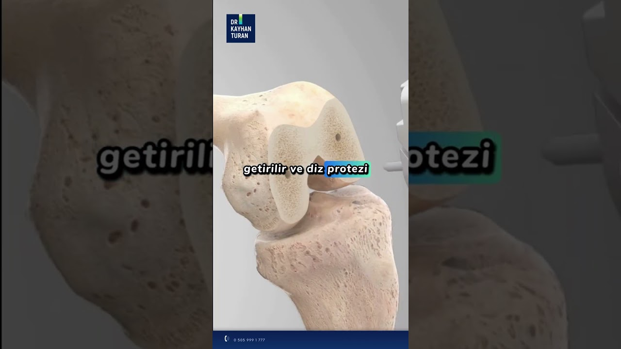 Robotik Diz Protezi Ameliyatı Nedir? Avantajları Nelerdir? l Op. Dr. Kayhan Turan