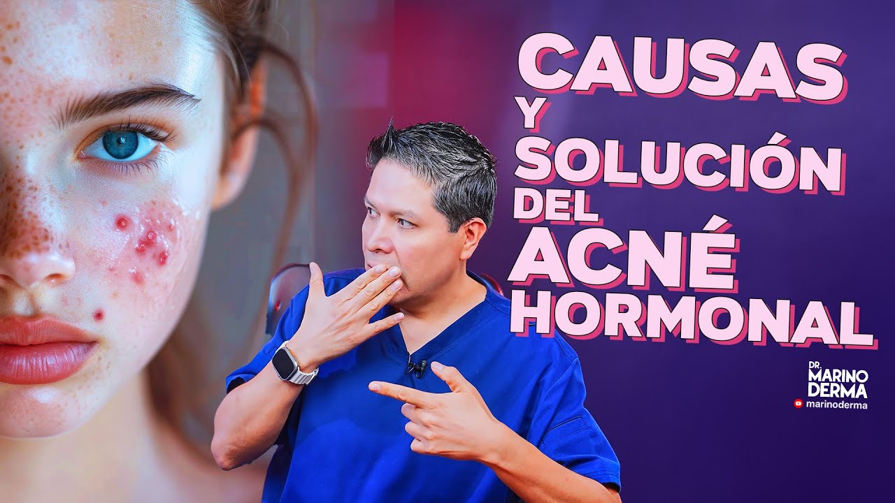 CAUSAS Y SOLUCI&Oacute;N DEL ACN&Eacute; HORMONAL