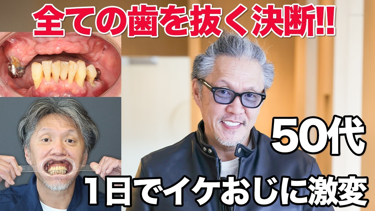 【必見】歯が無くてもここまで変わる！これがオールオン治療の真骨頂
