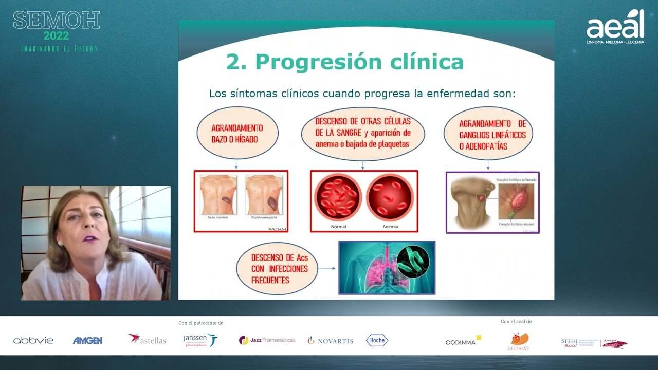 Linfoma linfocítico - leucemia linfocítica crónica, ¿caminando hacia la cronicidad?