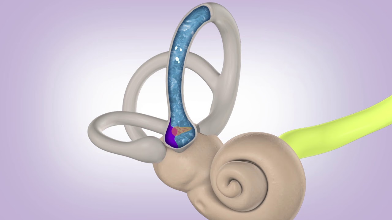 BPPV Cupulolithiasis