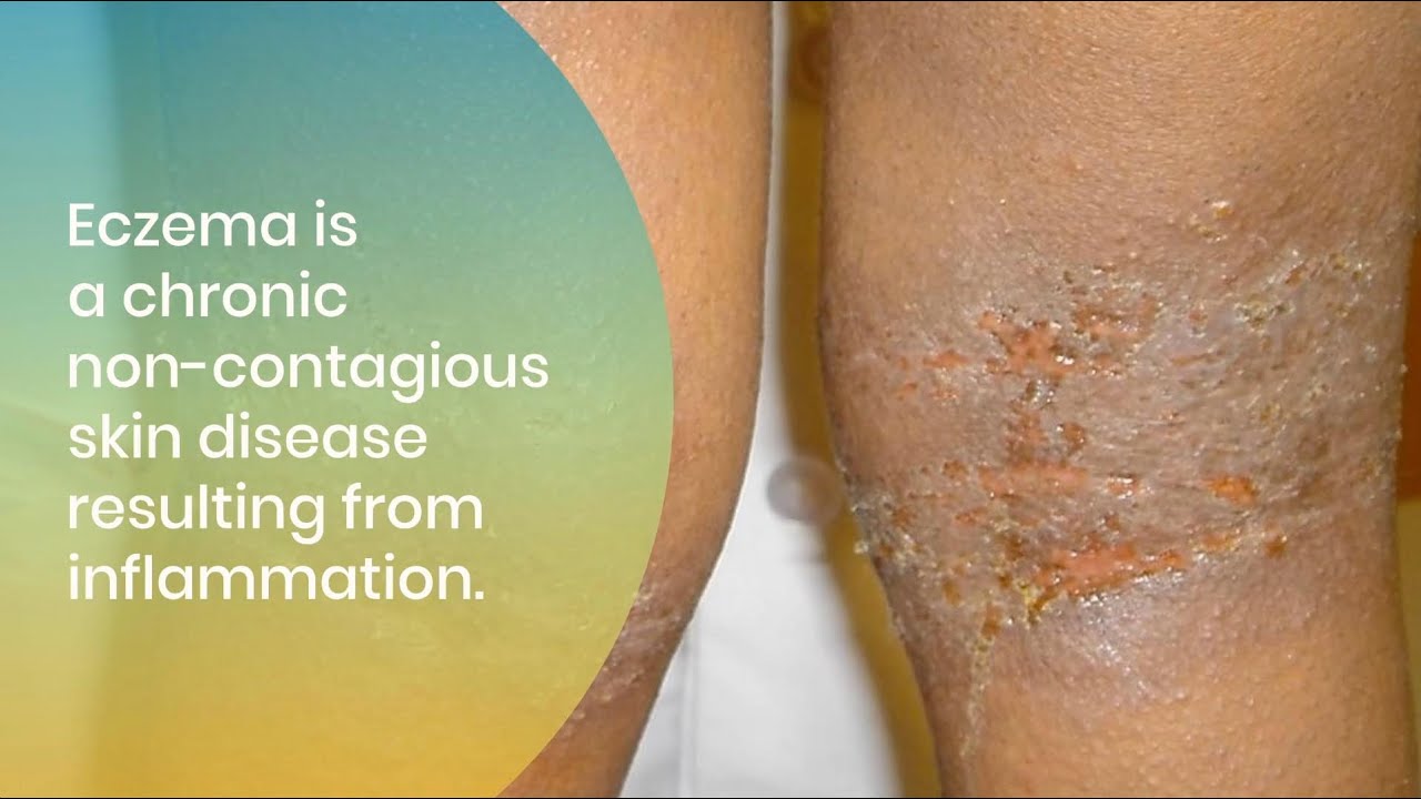 Treating and Managing Eczema in All Skin of Colors