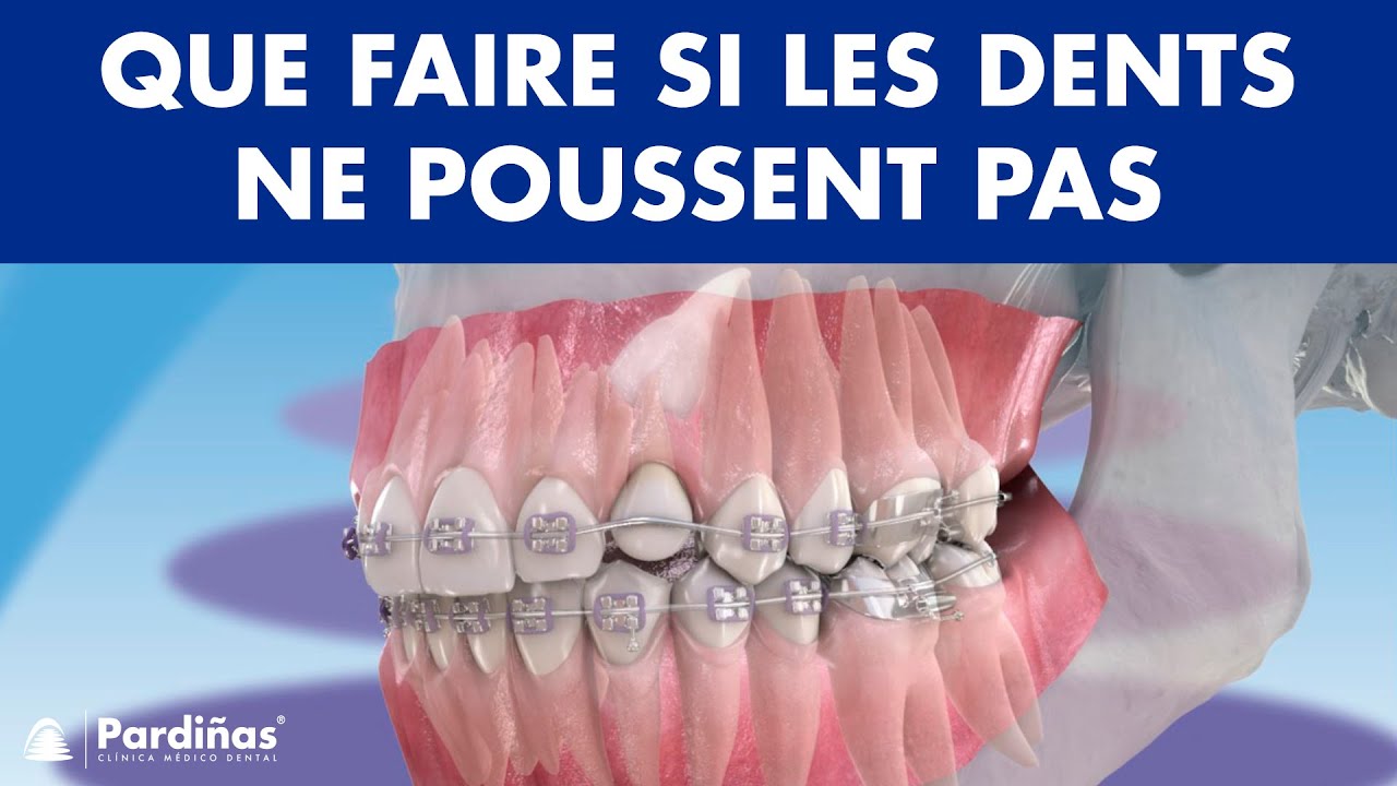 DENT INCLUSE - Que faire si les CANINES ou autres dents permanentes ne rentrent pas ©