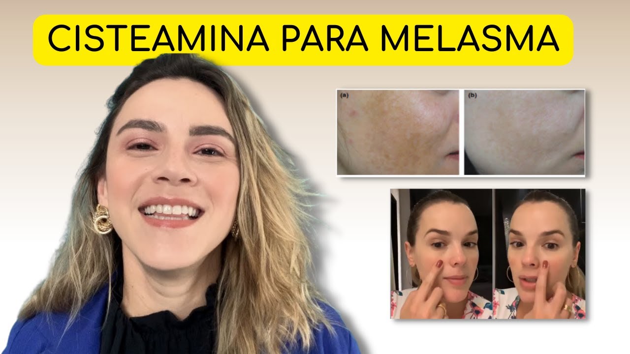 CISTEAMINA É MAIS POTENTE QUE A HIDROQUINONA?