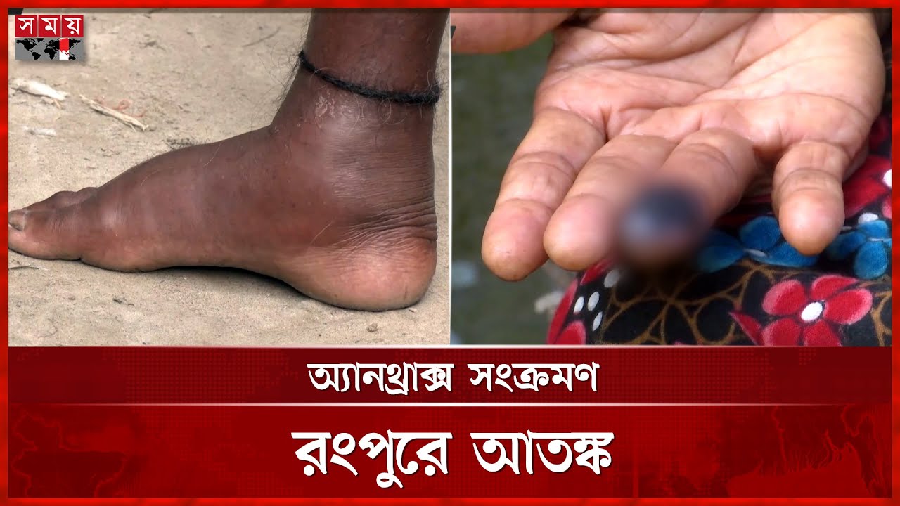 গরু থেকে মানুষে ছড়িয়ে পড়ছে অ্যানথ্রাক্স, মহামারীর শঙ্কা | Rangpur | Anthrax outbreak | Somoy TV