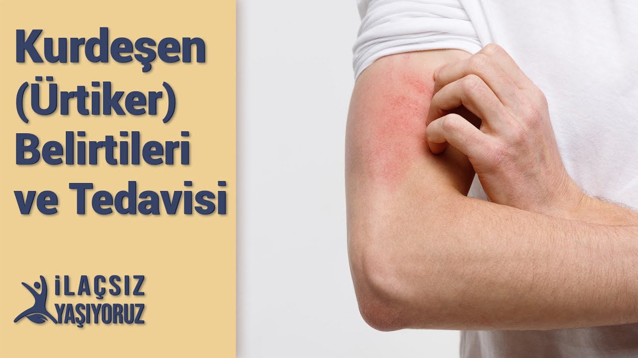 Kurdeşen (&Uuml;rtiker) Tedavisi❗
