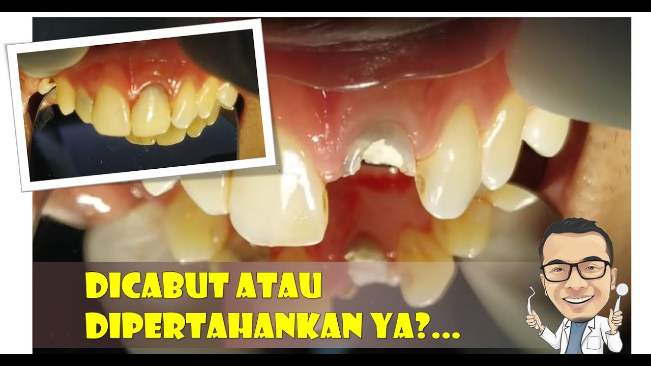 perawatan sambung gigi depan patah dengan pasak dan tambalan