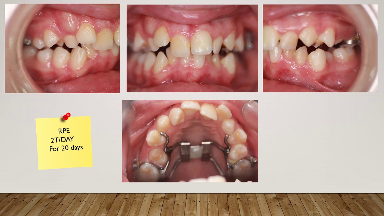 Severe crowding case treated Non Extraction