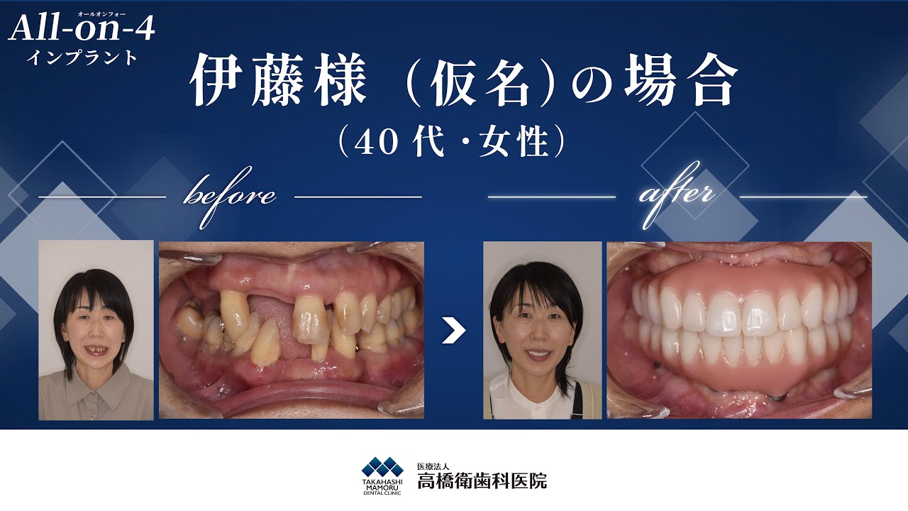 All-on-4(オールオンフォー)インプラント症例モニター/伊藤様（仮名）40代女性