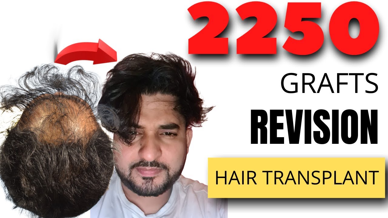 Hair Transplant Revision using 2250 grafts | Hair transplant without Finasteride