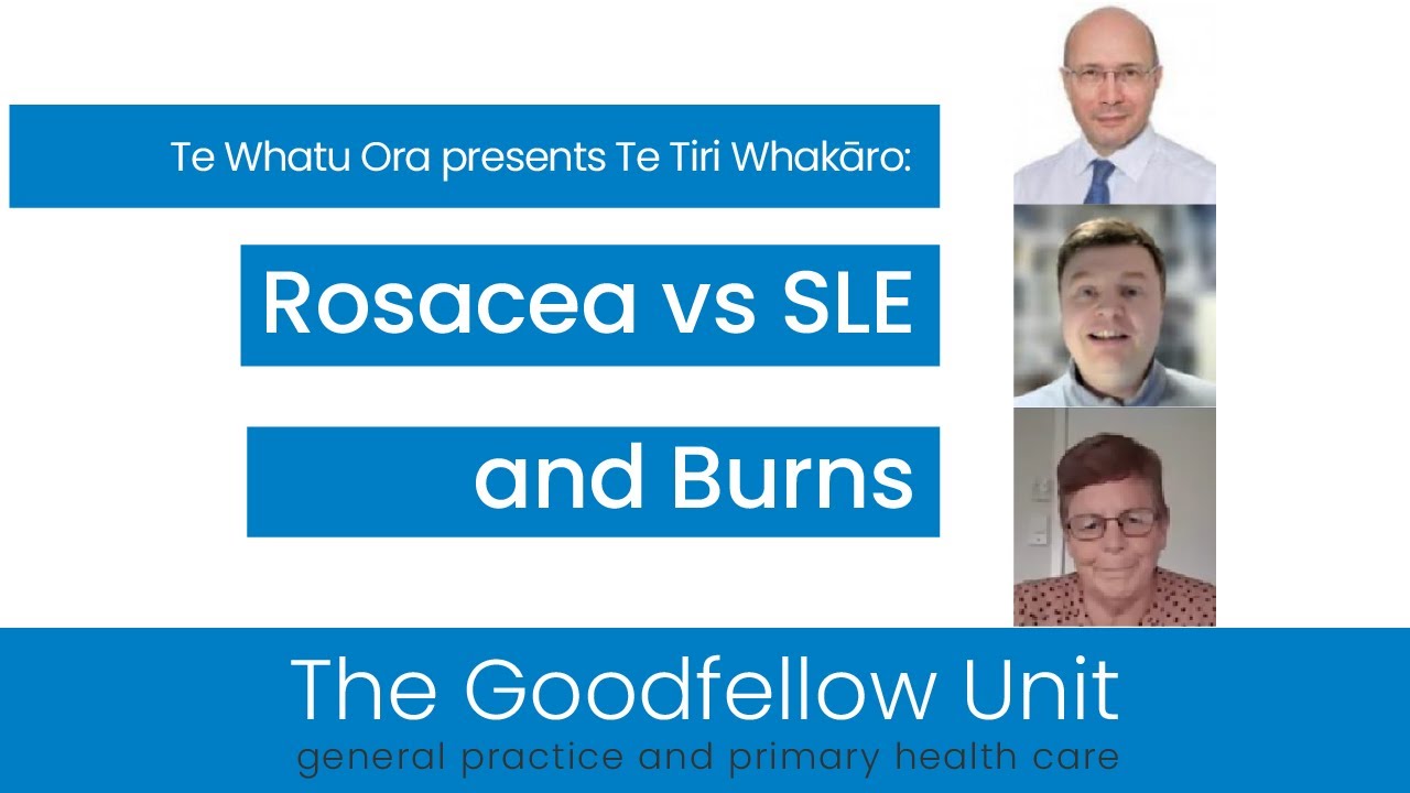 Skin: Rosacea vs SLE, and Burns