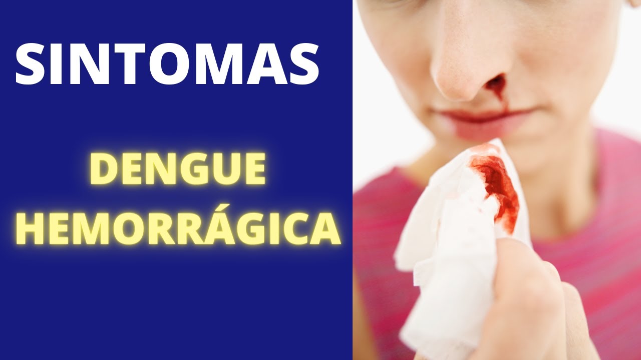 Sintomas da DENGUE HEMORRÁGICA ou DENGUE GRAVE: O Que é - Sinais e  Sintomas e TRATAMENTO