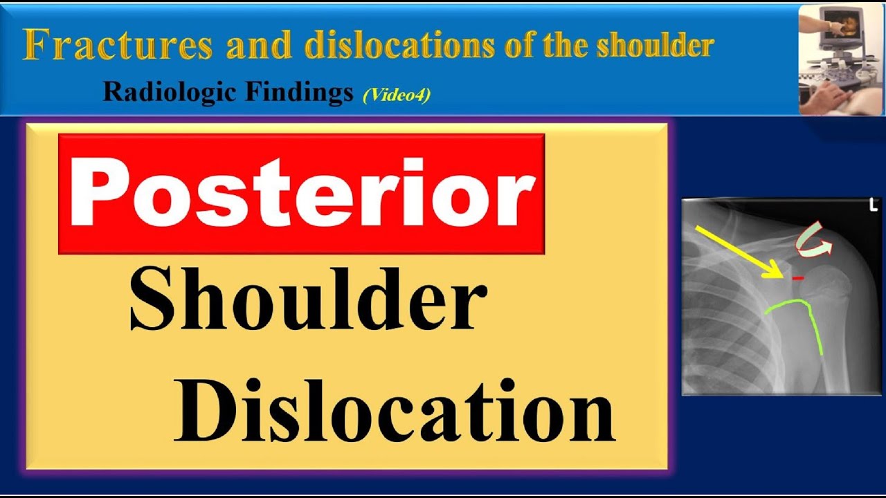 Posterior Shoulder Dislocation Key Radiologic Findings Explained