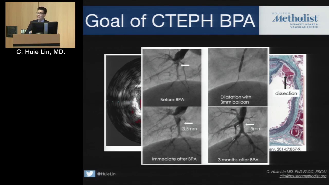 Pulmonary Balloon Angioplasty: State-of-the-Art Lecture (C. Huie Lin, MD)