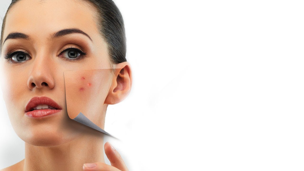 How To Treat Acne Scars - Expert Advice - Post Acne Skin Care - Glamrs