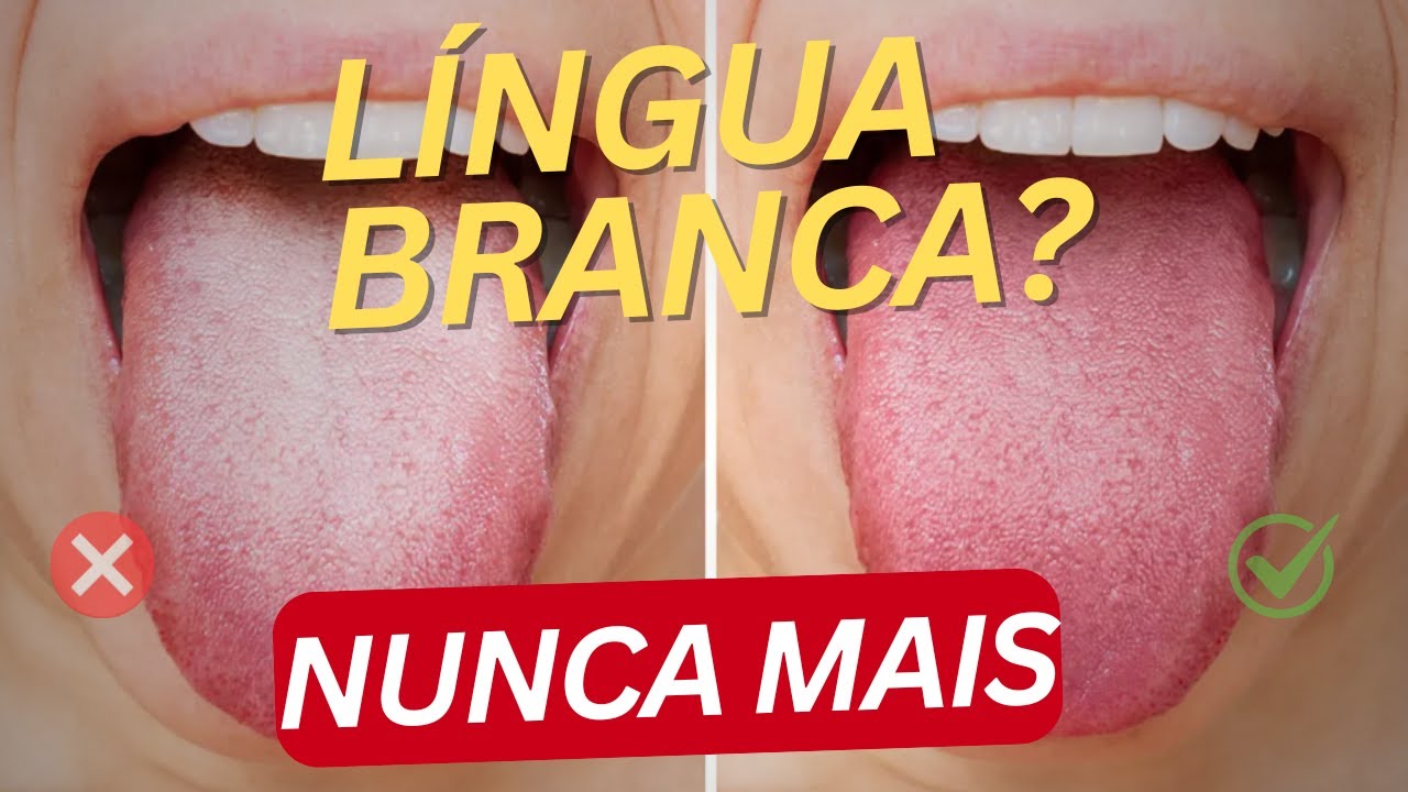Língua Branca? Mau hálito? Descubra tudo sobre a Saburra Lingual!