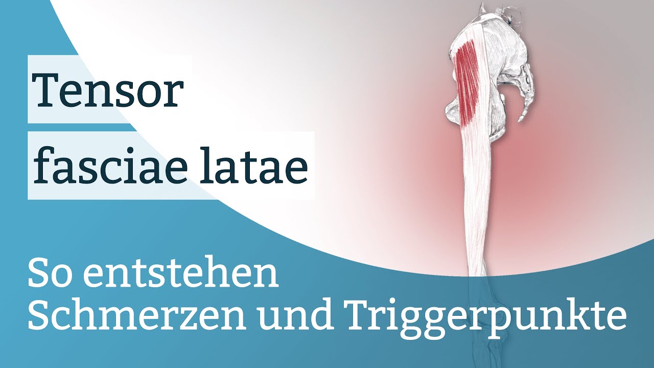 Tensor fasciae latae Schmerzen, Triggerpunkte und deren Aktivierung