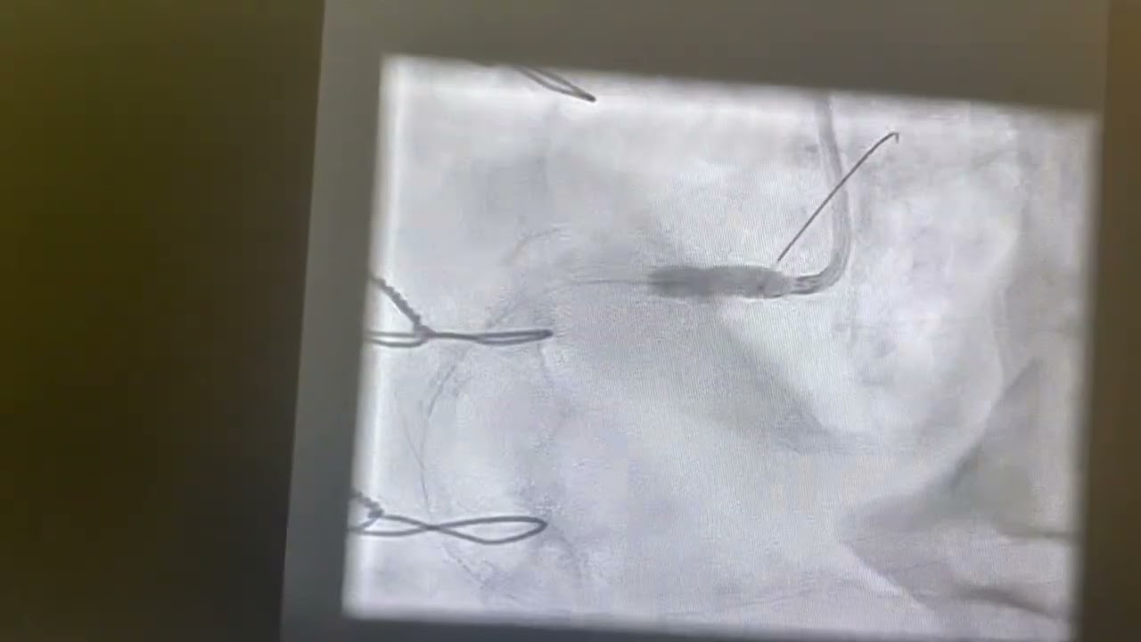 IVL assisted Intervention of ostial RCA stenosis