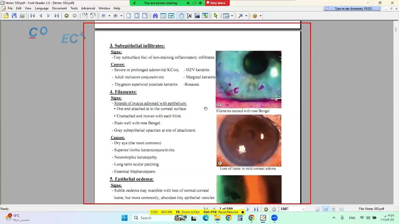 Kanski Ophthalmology | أسرار تشخيص إصابات القرنية: Superficial vs Deep Lesions – Lecture 1