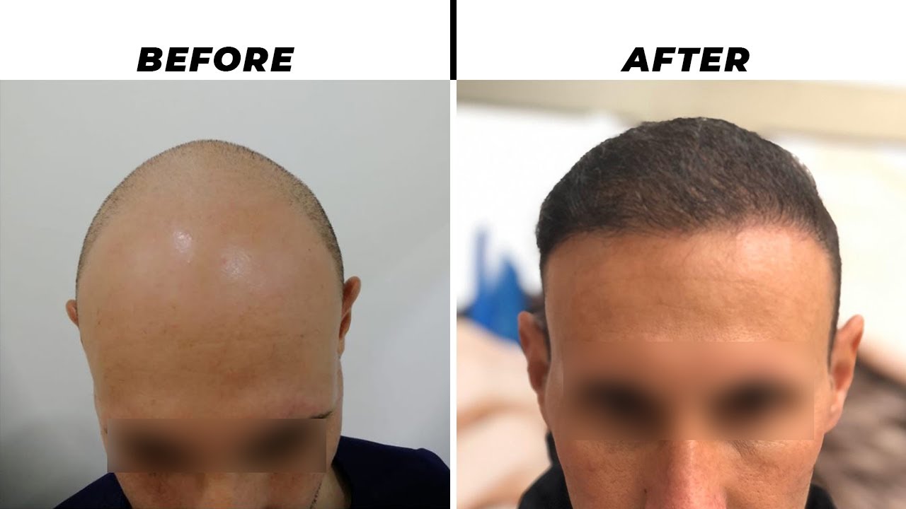 7 MONTH LATER | 5200 GREFT | HAIR TRANSPLANT