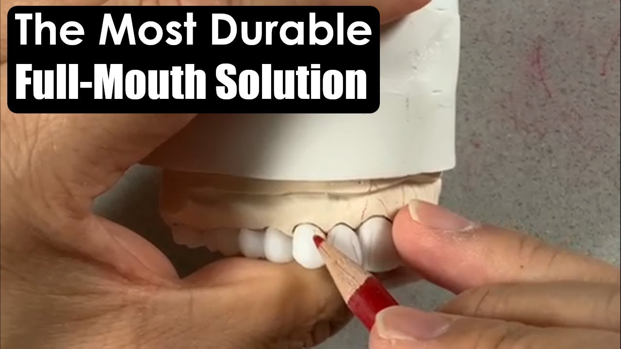 Making the Most Durable Full-Mouth Implant Solution