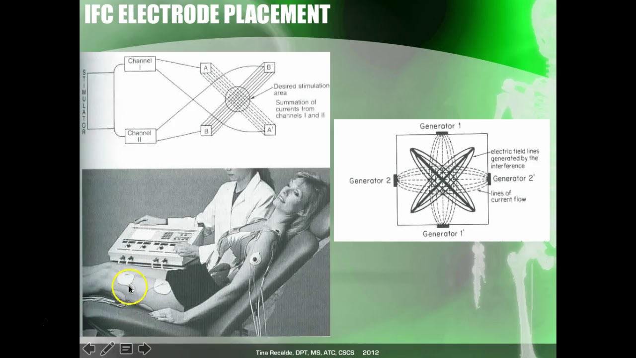 Electrical Stimulation #5-IFC