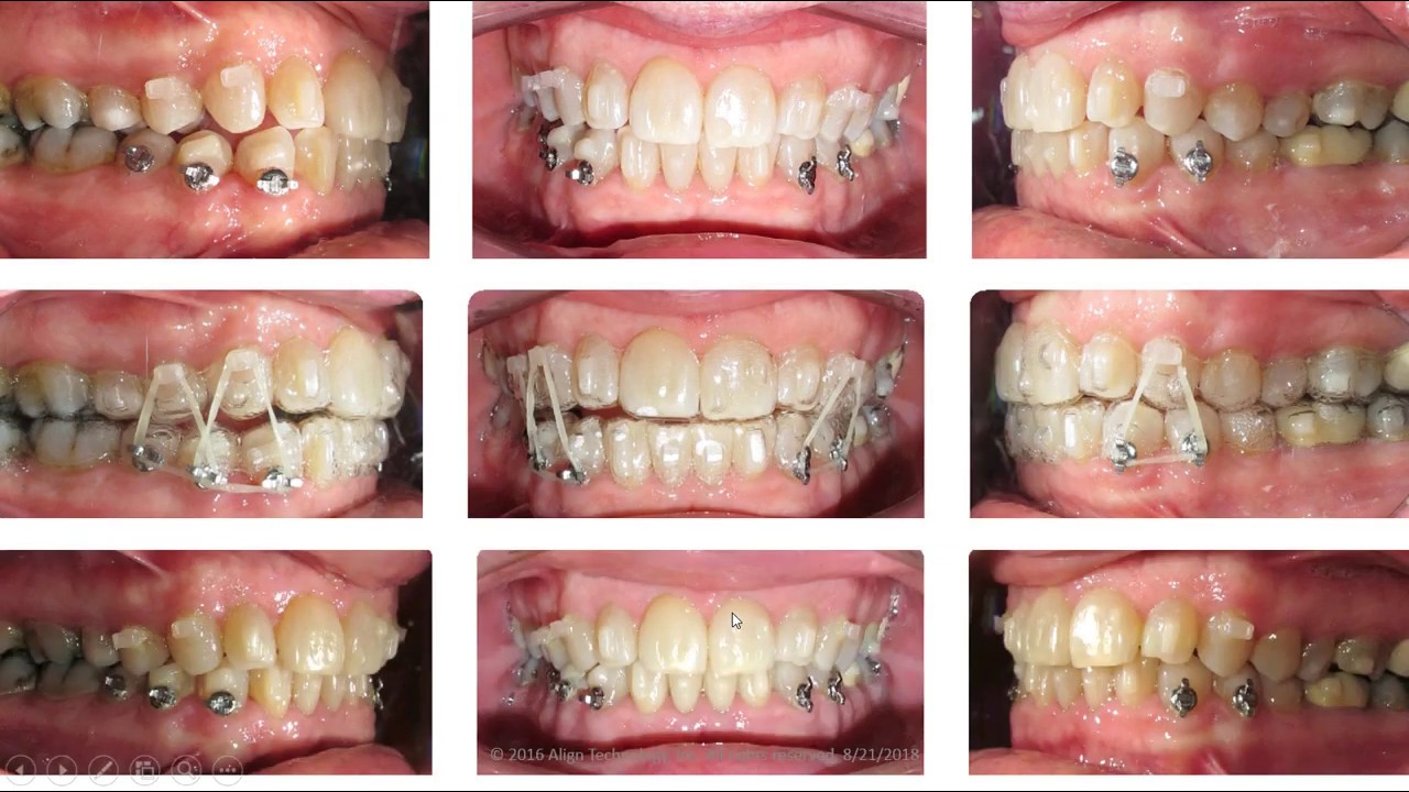Quick Tip -  10 Ways Aligners Cause Posterior Openbites And How To Avoid Them