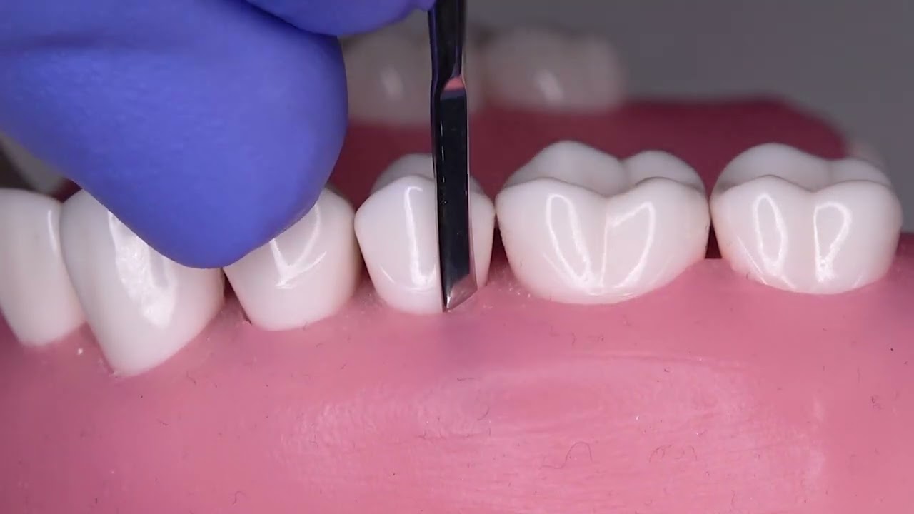 Full Thickness Reflection Technique