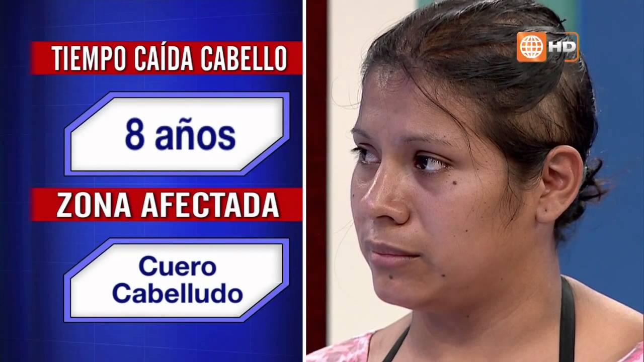 Alopecia por Dermatitis Seborreica Crónica