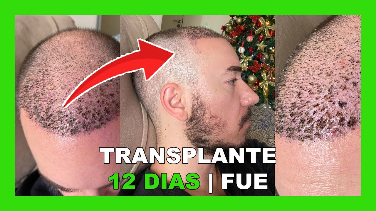 COMO CUIDAR DO TRANSPLANTE CAPILAR FUE NOS PRIMEIROS DIAS