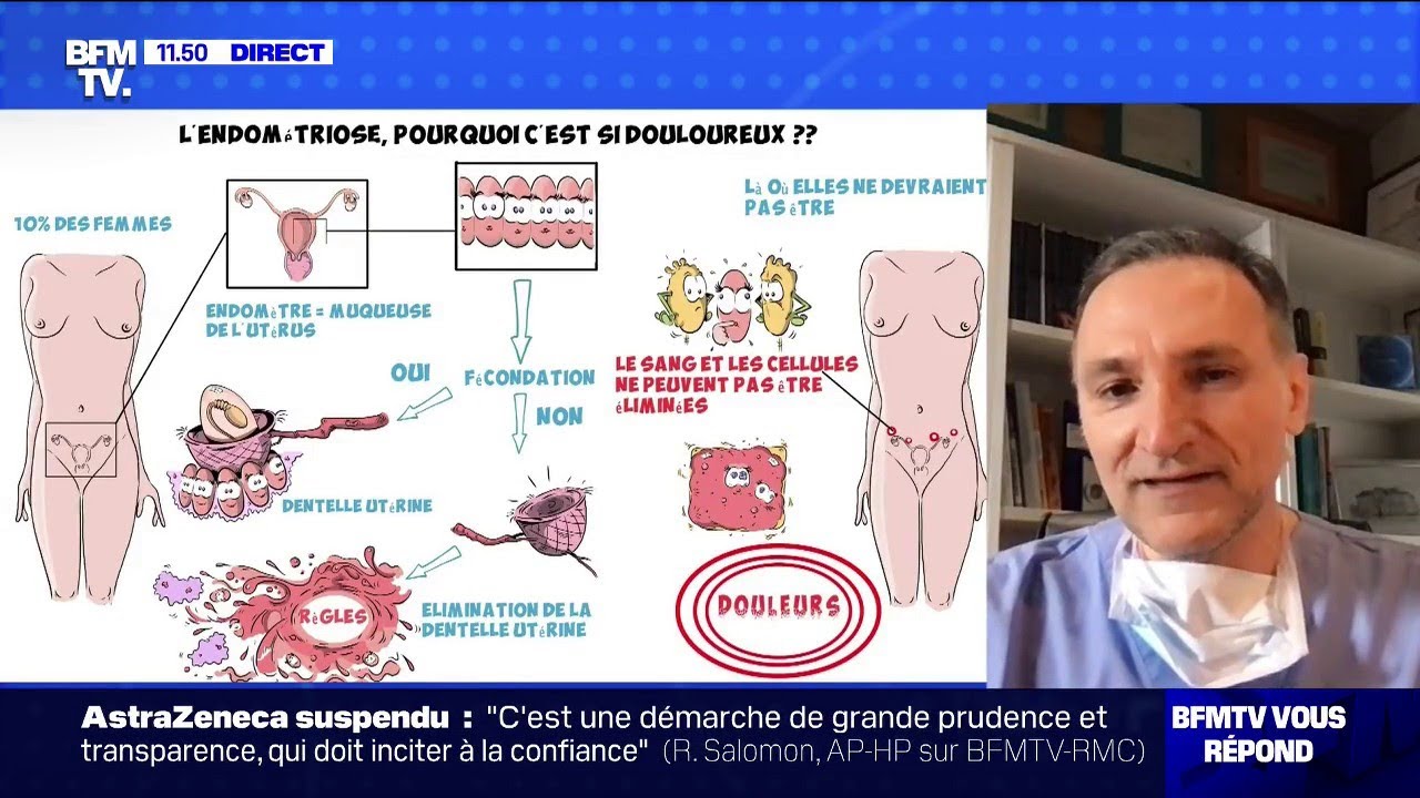 L'endométriose bientôt reconnue comme affection longue durée ? BFMTV répond à vos questions