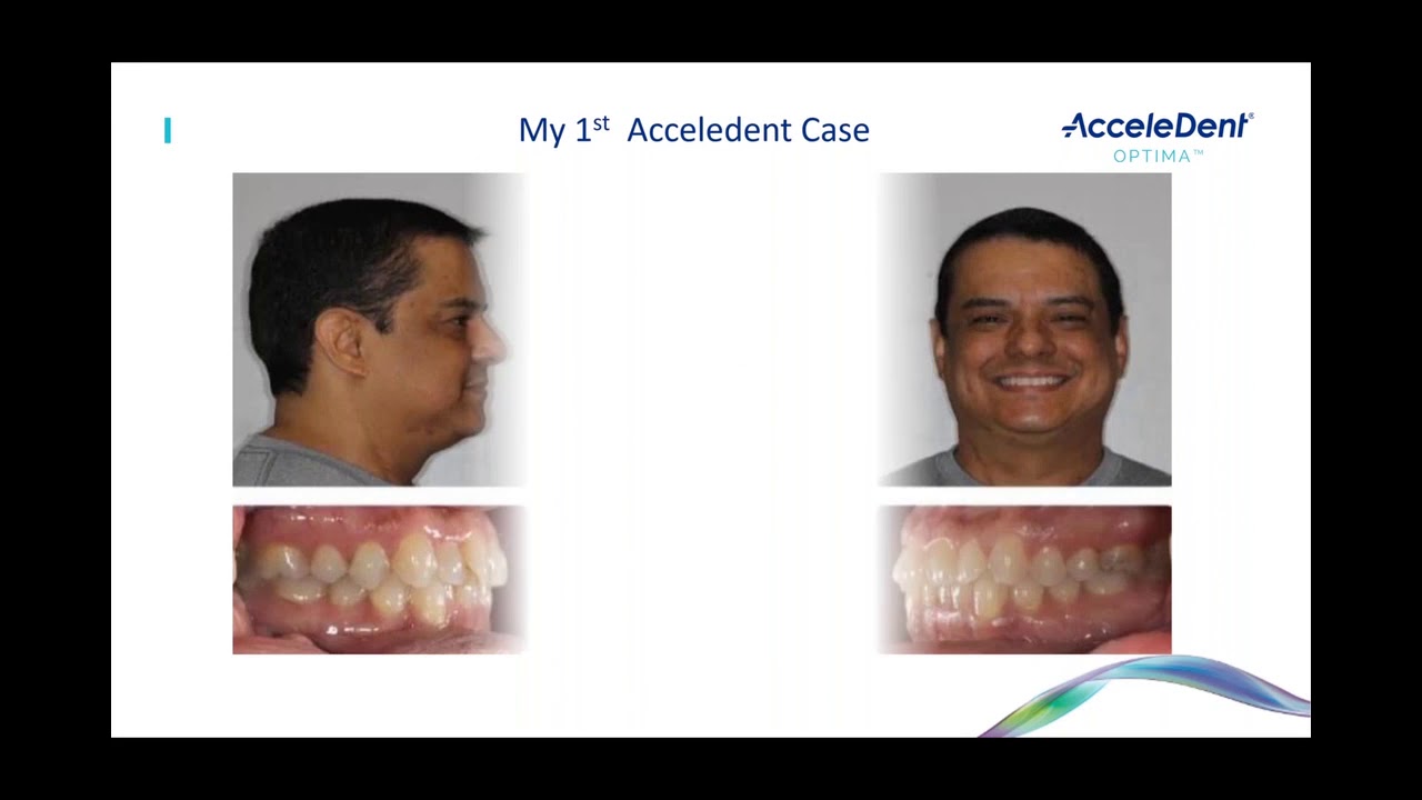 Webinar: AcceleDent® Amplify clinical confidence and predictability in aligner therapy