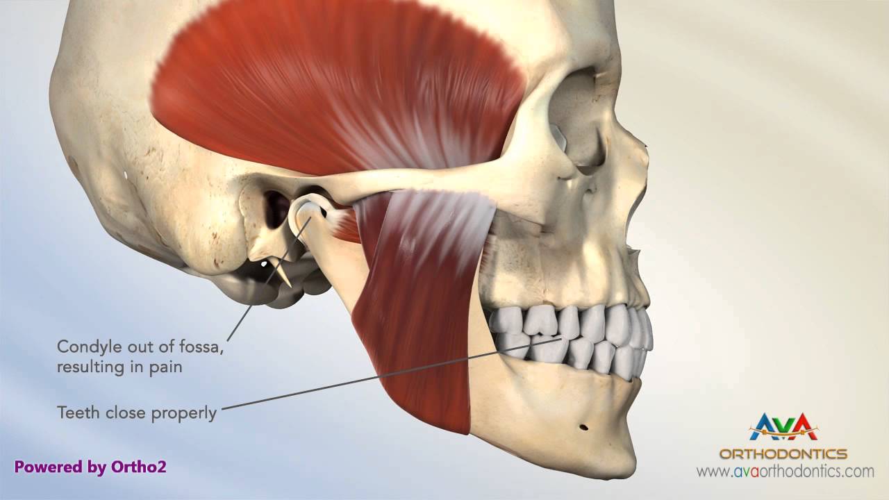 TMJ Disorder or TMD - Pain Due to Malocclusion