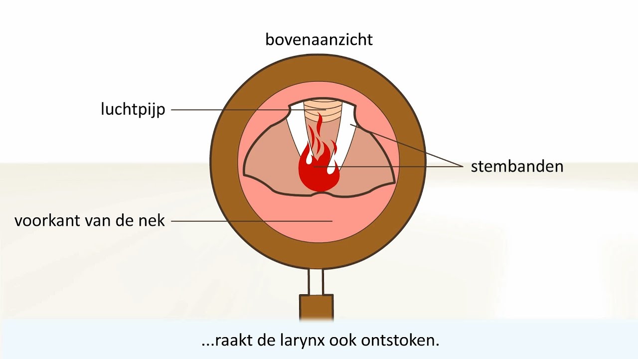 Keelontsteking - de oorzaak en behandeling