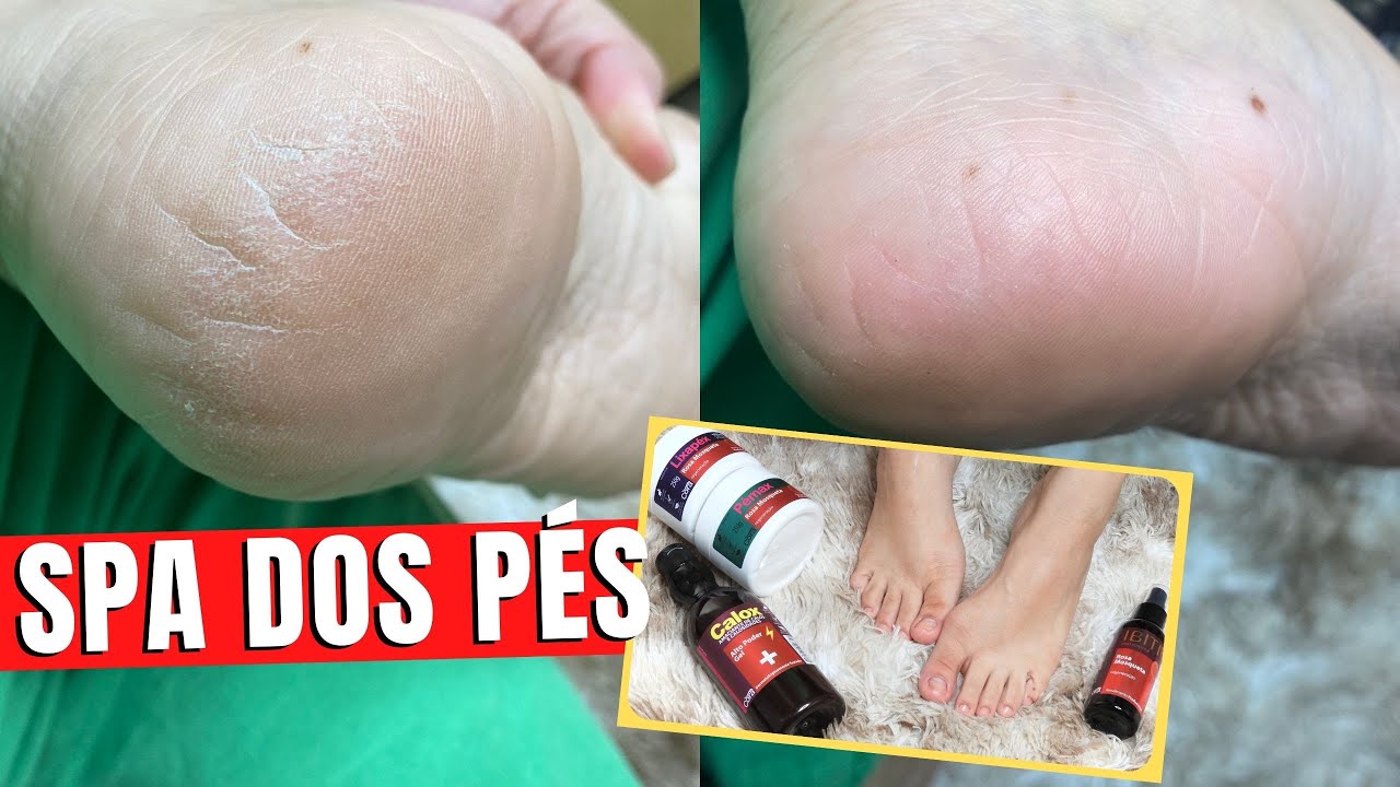 SPA DOS PÉS Removendo Calosidades com Produtos CORA