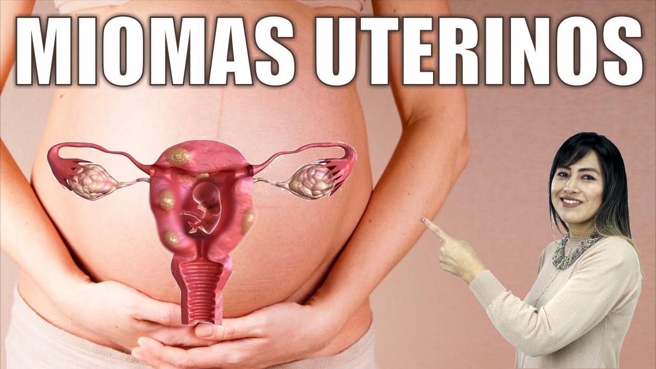 Puedo tener HIJOS con MIOMAS UTERINOS  🥵 Miomas o Fibromas y FERTILIDAD ⭐ Dra PILAR CHUQUILLANQUI
