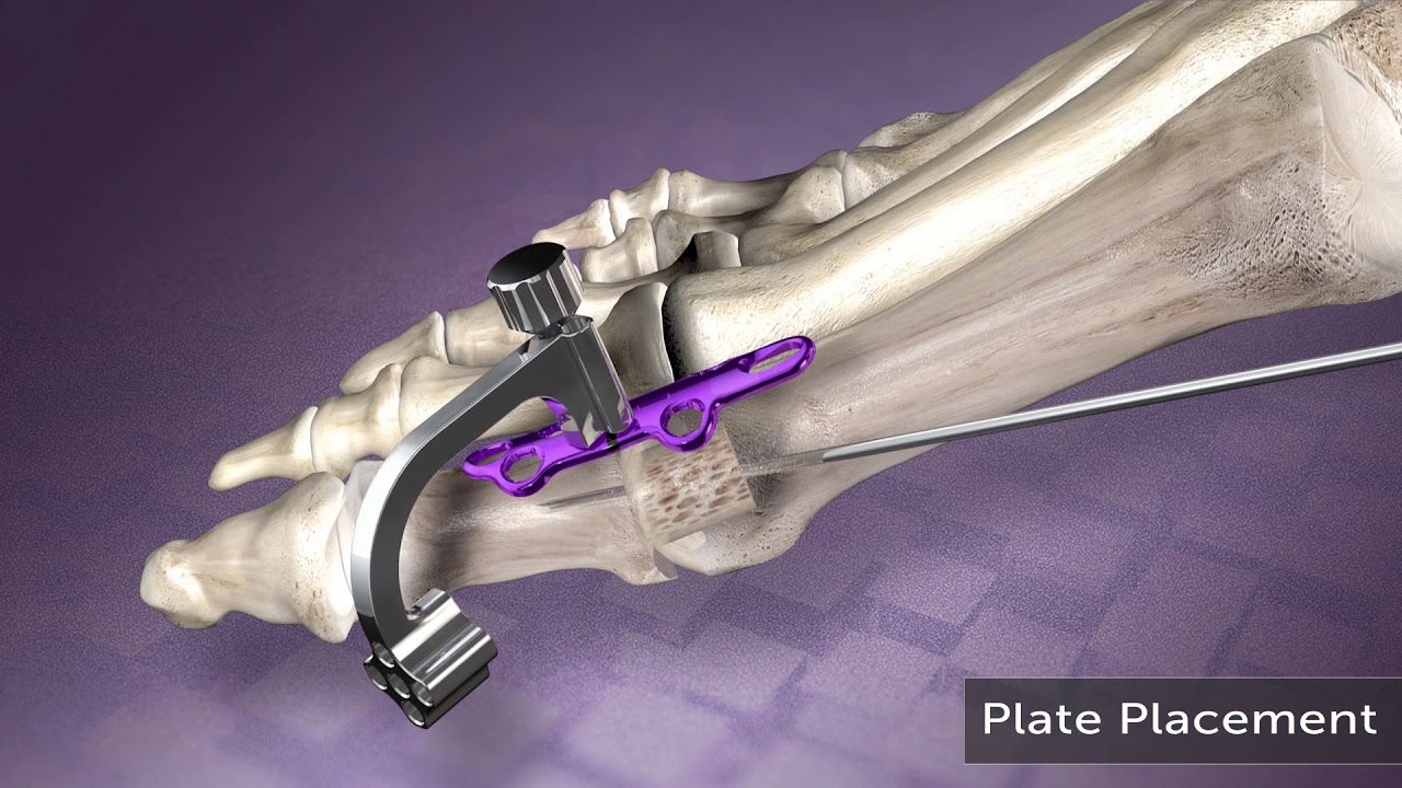 AVITRAC&trade; MTP Revision System Animation