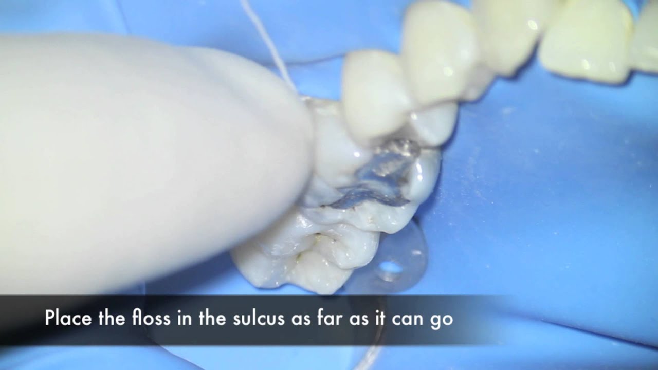 Floss ligatures on rubber dam