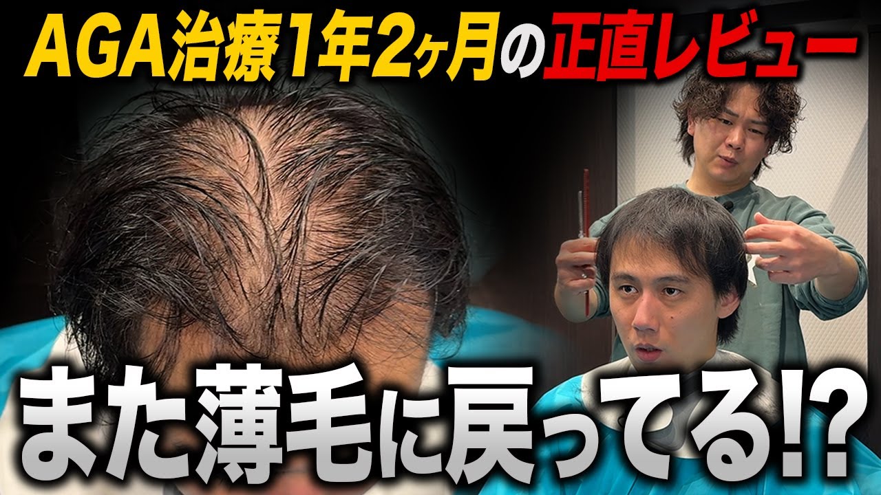 【30歳薄毛】治療薬を1年2ヶ月飲み続けたリアルな状態がヤバい...！