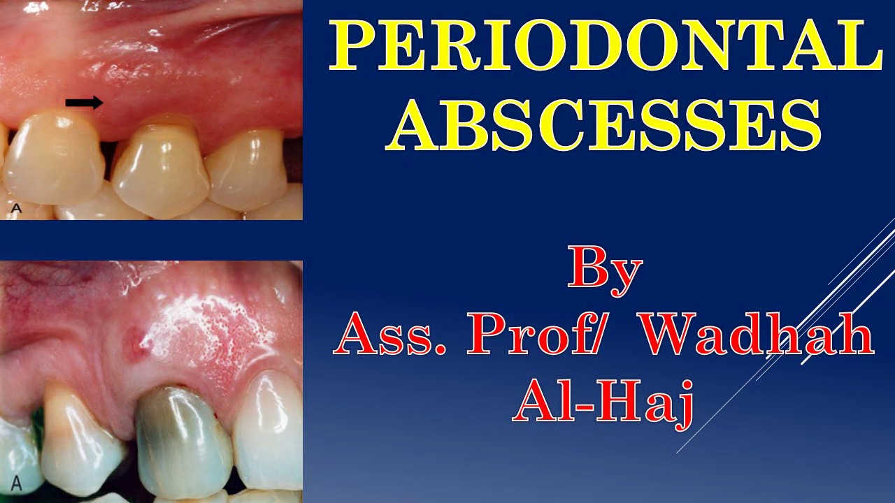 16- Periodontal diseases -6 (Periodontal abscesses)-Dr Wadhah Periodontology lectures. د/وضاح الحاج