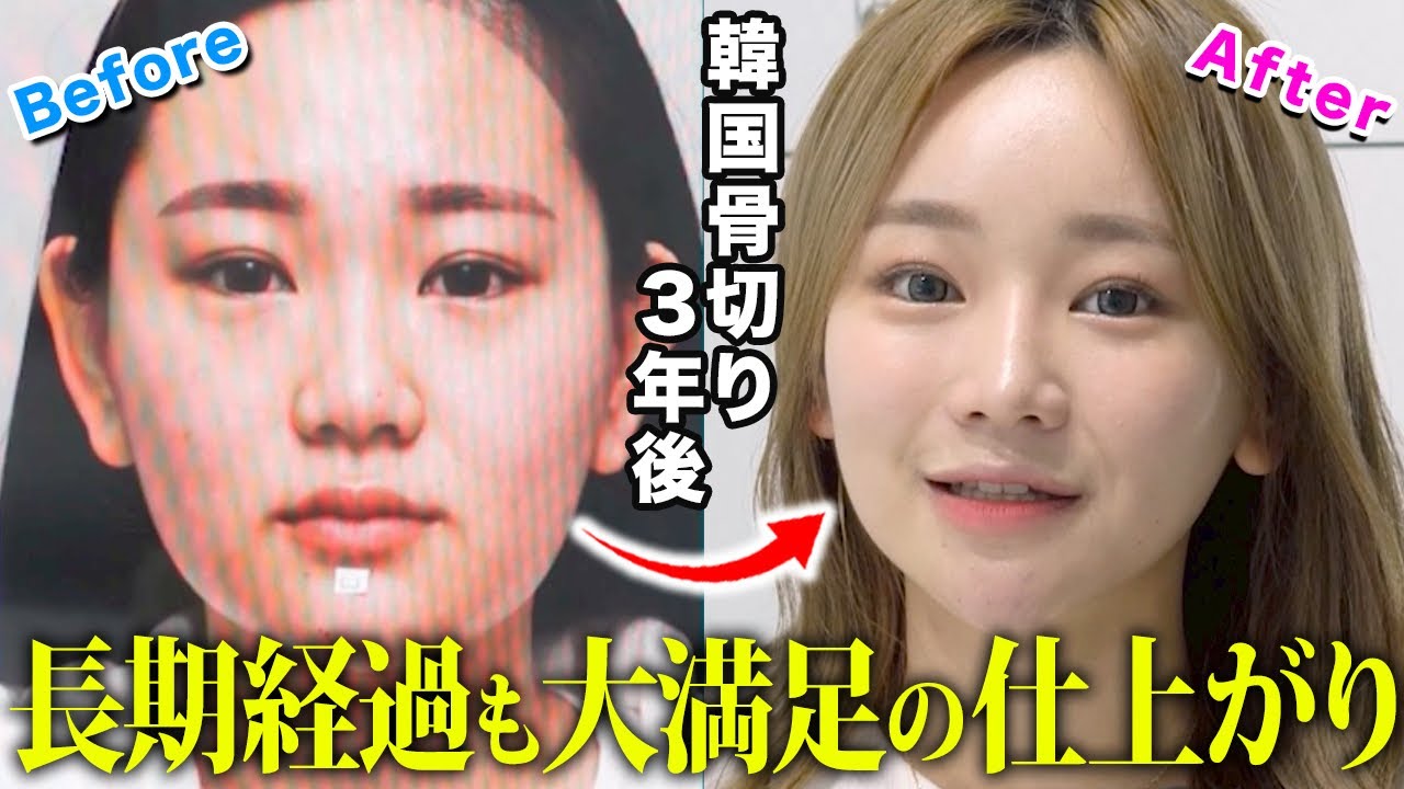 【韓国骨切り】当院で輪郭手術を受けてアイドル級に可愛くなった患者様の術後３年に密着