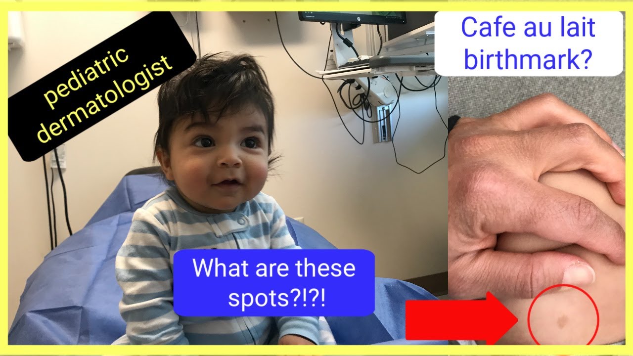 Brown Spots On Babies Skin| Cafe Au Lait