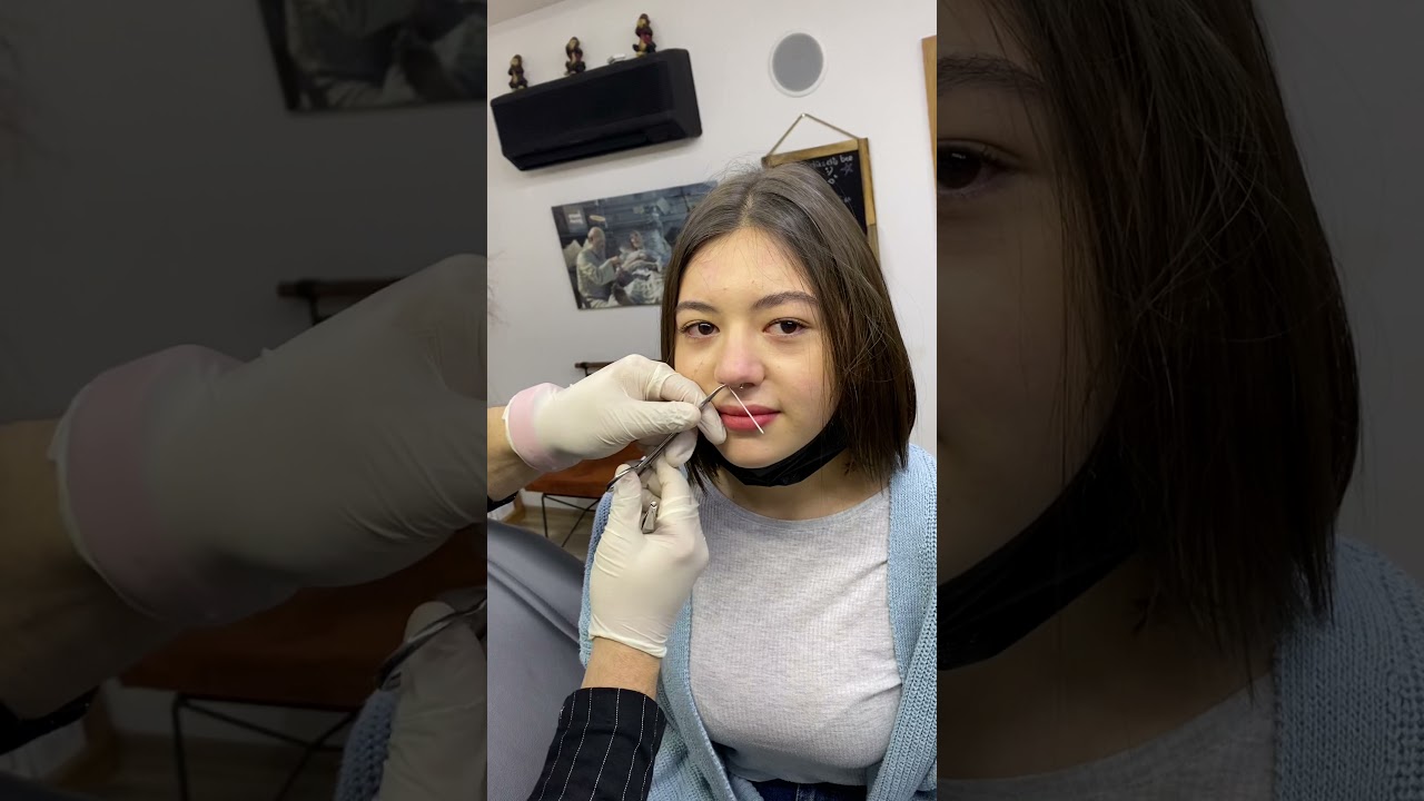 Septum delim işlemi
