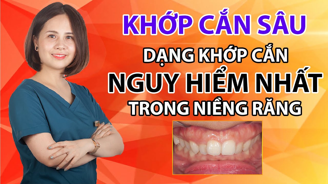 Chẩn đoán khớp cắn sâu | Hậu Quả Cắn Sâu | Tiêu chuẩn kết thúc ca niềng răng
