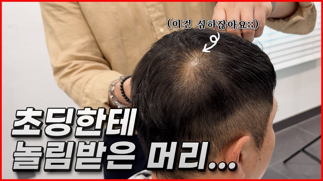 정수리탈모가 어렸을때부터 시작됐다? 정수리탈모, M자탈모, 전체빈모 이 영상 보시면 해결 가능요(두피문신의 효과, 변화, 청주두피문신)