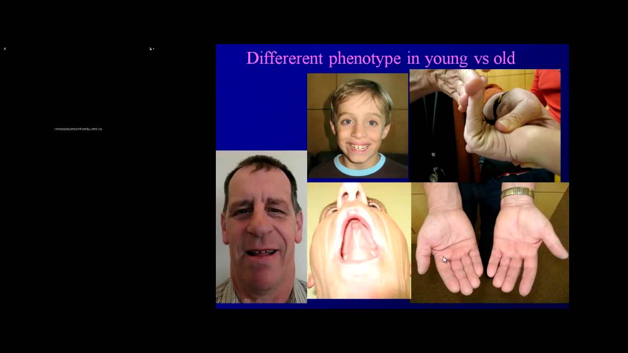 Fragile X syndrome: new advances, and RNA toxicity in FXTAS