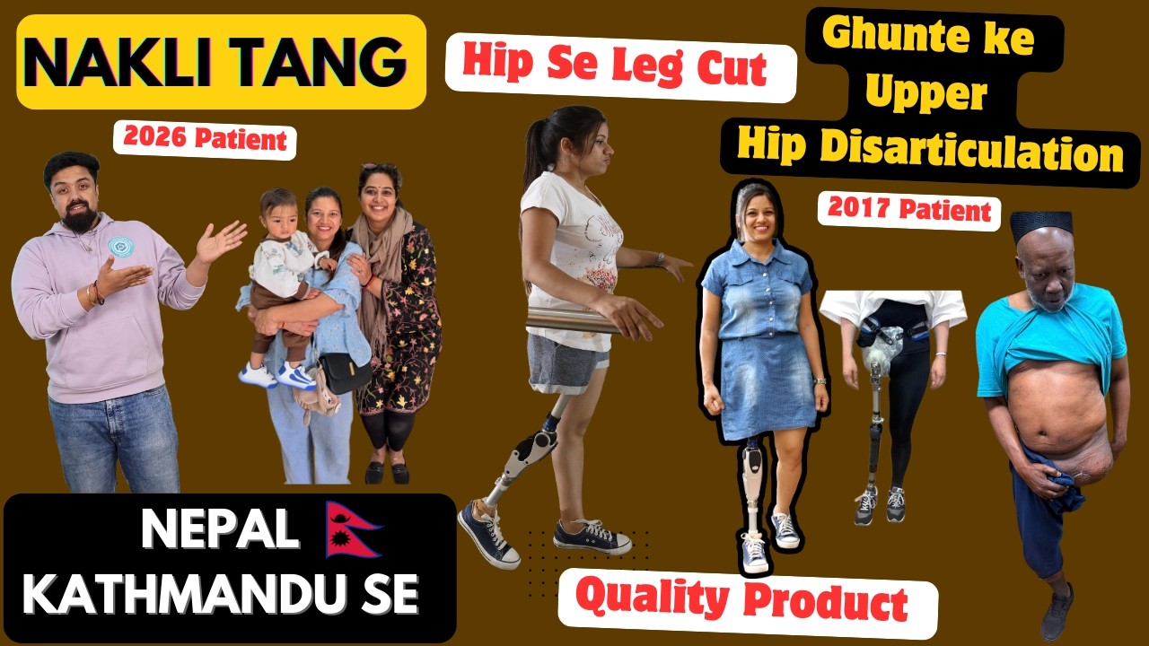 😰Hip Disarticulation Prosthetic Leg | Hydraulic Knee Joint | Artificial Leg Nepal | #ottobock #3r80
