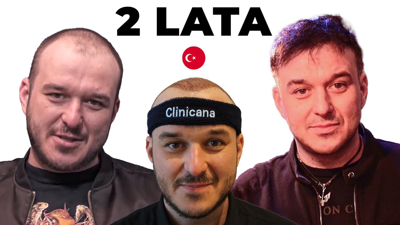 Moja 2-letnia przygoda z Przeszczepem Włosów w Turcji